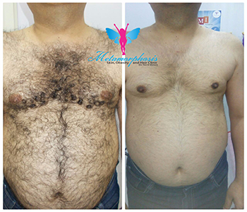 Laser Hair Removal Before After 2