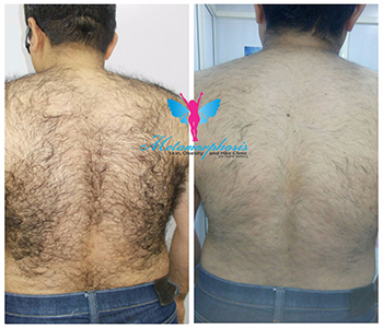 Laser Hair Removal Before After 3