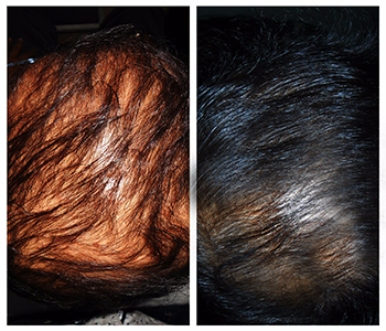 Hair Regain Therapy Before After