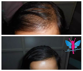 Hair Regain Therapy Before After