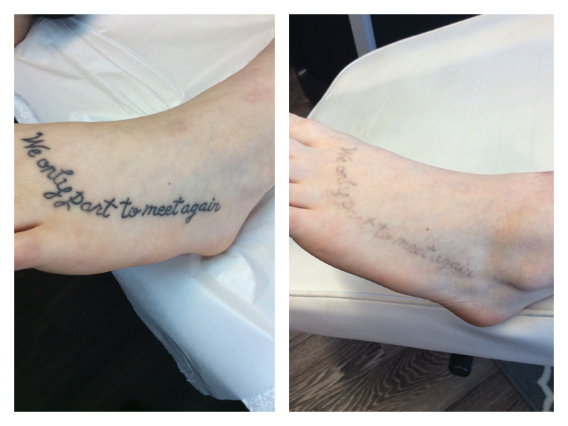 Before After Tattoo Foot